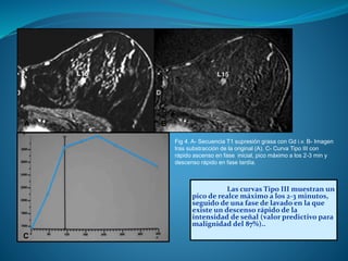 Las curvas Tipo III muestran un
pico de realce máximo a los 2-3 minutos,
seguido de una fase de lavado en la que
existe un descenso rápido de la
intensidad de señal (valor predictivo para
malignidad del 87%)..
Fig 4. A- Secuencia T1 supresión grasa con Gd i.v. B- Imagen
tras substracción de la original (A). C- Curva Tipo III con
rápido ascenso en fase inicial, pico máximo a los 2-3 min y
descenso rápido en fase tardía.
A B
C
 