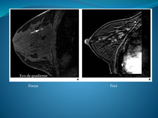 Focus Foci
Eco de gradiente
 