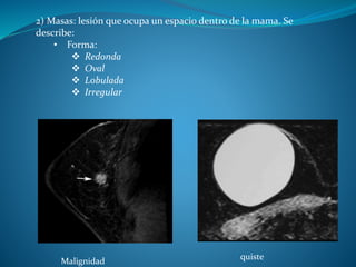 2) Masas: lesión que ocupa un espacio dentro de la mama. Se
describe:
• Forma:
 Redonda
 Oval
 Lobulada
 Irregular
quiste
Malignidad
 