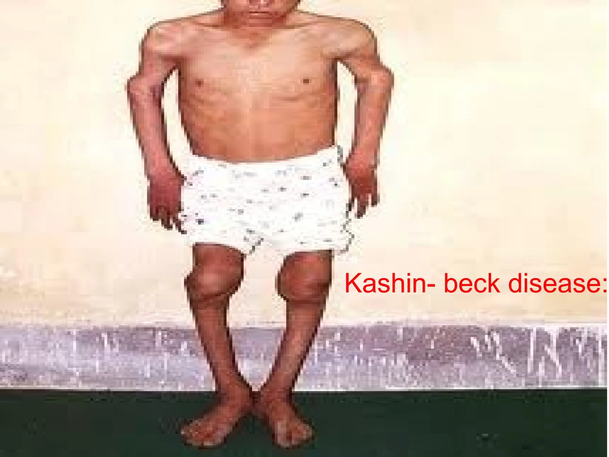 Kashin- beck disease:
 