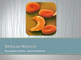 Na espécie humana – anemia falciforme

 
