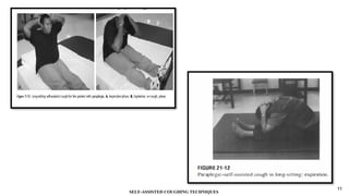 SELF-ASSISTED COUGHING TECHNIQUES IN PHYSIOTHERAPY.pptx