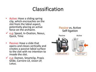 Classification
• Active: Have a sliding spring
clip, which encroaches on the
slot from the labial aspect,
potentially placing an active
force on the archwire.
 e.g: Speed, In-Ovation, Nexus,
Quick, Time
• Passive: Have a slide that
opens and closes vertically and
creates a passive labial surface
to the slot with no intention to
invade the slot.
 e.g: Damon, Smartclip, Praxis
Glide, Carriere LX, vision LP,
Lotus.
 