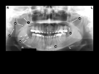 Perfect Pan Radiograph Self study-pan-anatomy | PPT