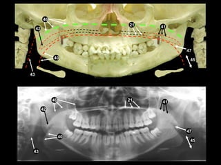 Perfect Pan Radiograph Self study-pan-anatomy | PPTX