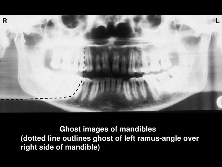 Panoramic Radiograph Anatomy