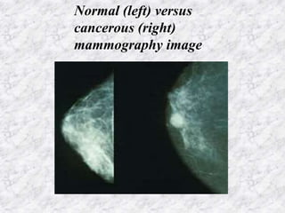 Normal (left) versus
cancerous (right)
mammography image
 