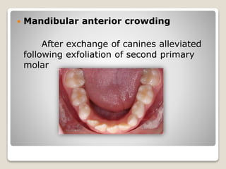  Mandibular anterior crowding
After exchange of canines alleviated
following exfoliation of second primary
molar
 