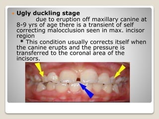  Ugly duckling stage
due to eruption off maxillary canine at
8-9 yrs of age there is a transient of self
correcting malocclusion seen in max. incisor
region
* This condition usually corrects itself when
the canine erupts and the pressure is
transferred to the coronal area of the
incisors.
 