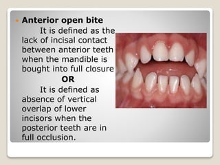  Anterior open bite
It is defined as the
lack of incisal contact
between anterior teeth
when the mandible is
bought into full closure
OR
It is defined as
absence of vertical
overlap of lower
incisors when the
posterior teeth are in
full occlusion.
 