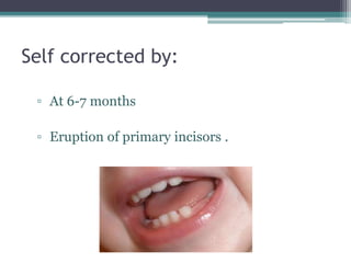Self corrected by:
▫ At 6-7 months
▫ Eruption of primary incisors .
 