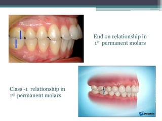 Class -1 relationship in
1st permanent molars
End on relationship in
1st permanent molars
 