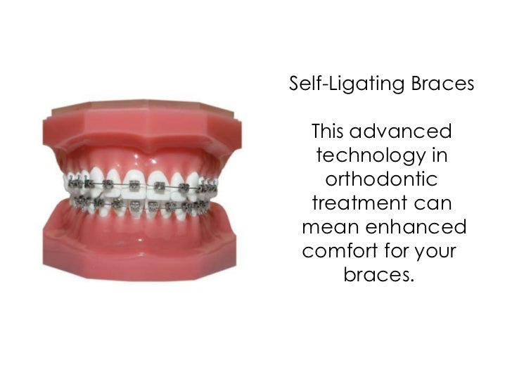 SelfLigating Braces Orthodontists in Grand Rapids