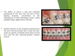 SELF LIGATING BRACKETS In orthodontics as | PPTX