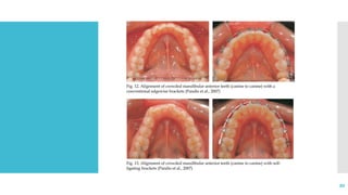 Self ligating Bracket System.pptx................ | PPTX