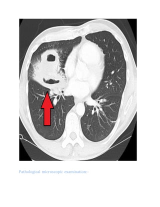 Pathological microscopic examination:-
 