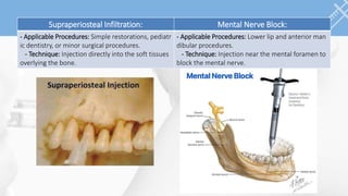 local anesthesia in dentistry terms and indications | PPT