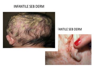 Seborrheic dermatitis