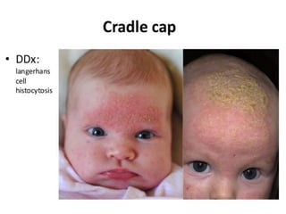 Seborrheic dermatitis