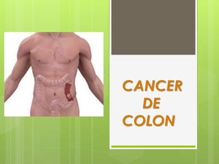 CANCER
DE
COLON
 