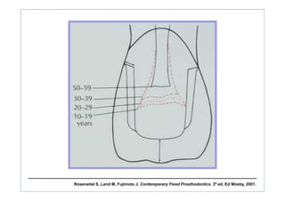 Rosenstiel S, Land M, Fujimoto J. Contemporary Fixed Prosthodontics. 3ª ed. Ed Mosby, 2001.
 