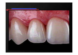 Sellado inmediato de la dentina