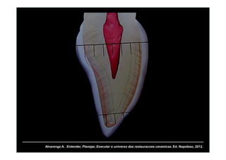 Alvarenga A. Entender, Planejar, Executar o universo das restauracoes ceramicas. Ed. Napoleao, 2012.
 