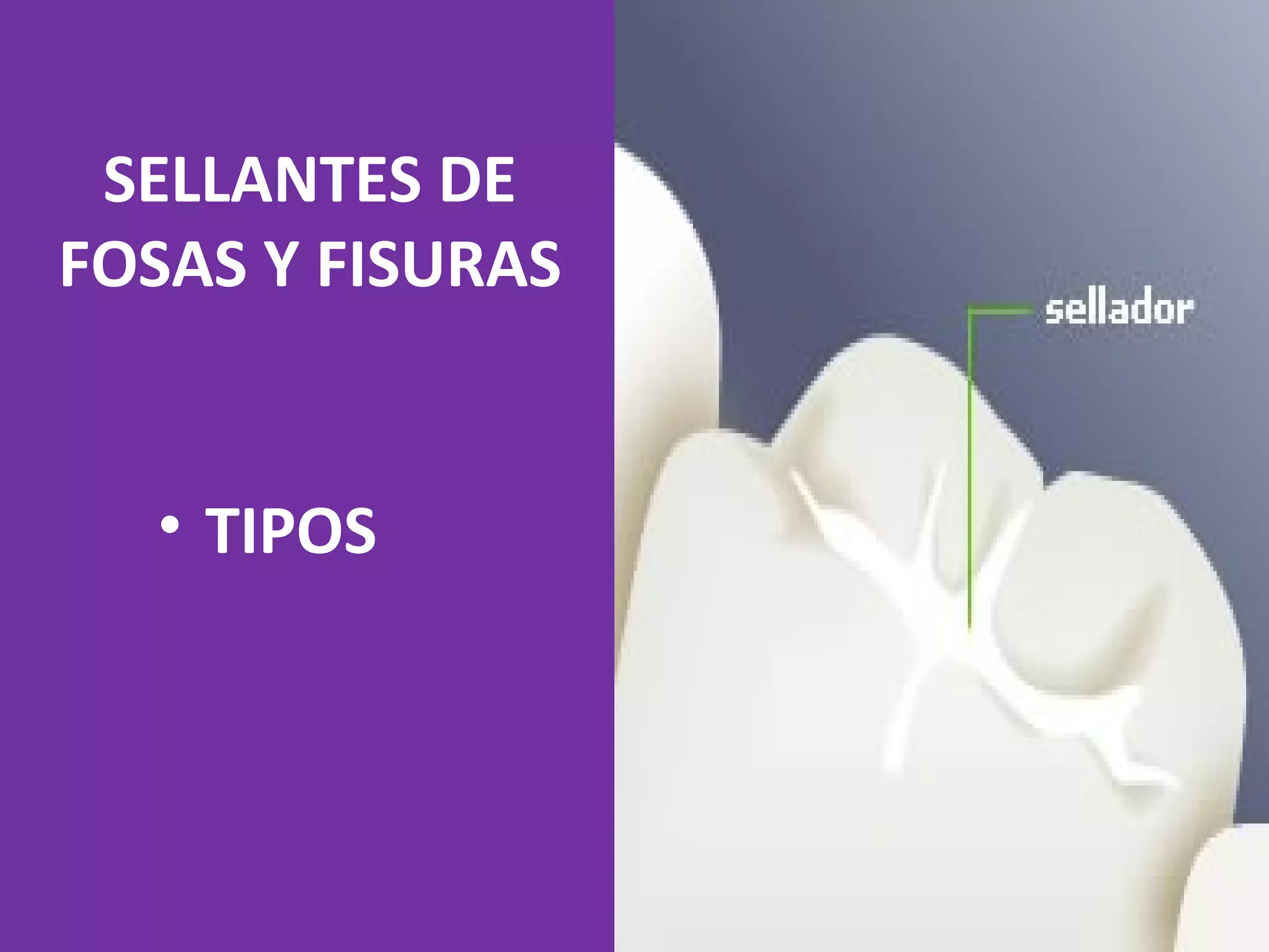 Selladores de fosas y fisuras.ppt tipos | PPT