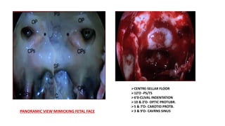 PANORAMIC VIEW MIMICKING FETAL FACE
CENTRE-SELLAR FLOOR
12’O -PS/TS
6’0-CLIVAL INDENTATION
10 & 2’O- OPTIC PROTUBR.
5 & 7’O- CAROTID PROTB.
3 & 9’O- CAVRNS SINUS
 