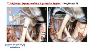 Subfrontal Exposure of the Suprasellar Region: transfrontal TS
Scalp incision, right frontal bone flap,
dural incision, and placement of self
retaining retractor
 
