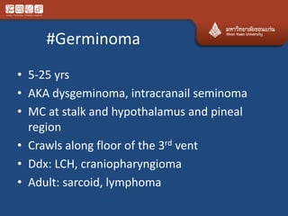 #Germinoma
• 5-25 yrs
• AKA dysgeminoma, intracranail seminoma
• MC at stalk and hypothalamus and pineal
region
• Crawls along floor of the 3rd vent
• Ddx: LCH, craniopharyngioma
• Adult: sarcoid, lymphoma
 