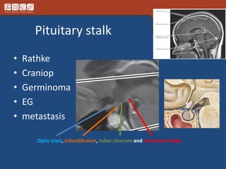 Pituitary stalk
• Rathke
• Craniop
• Germinoma
• EG
• metastasis
Optic tract, infundibulum, tuber cinerum and mammary body
 