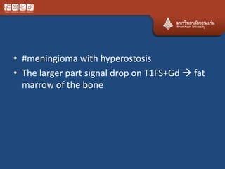 • #meningioma with hyperostosis
• The larger part signal drop on T1FS+Gd  fat
marrow of the bone
 