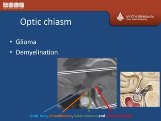 Optic chiasm
• Glioma
• Demyelination
Optic tract, infundibulum, tuber cinerum and mammary body
 
