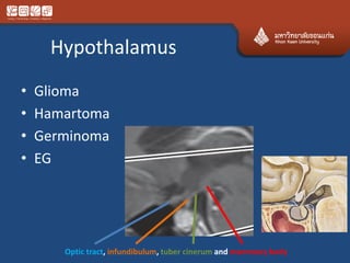 Hypothalamus
• Glioma
• Hamartoma
• Germinoma
• EG
Optic tract, infundibulum, tuber cinerum and mammary body
 