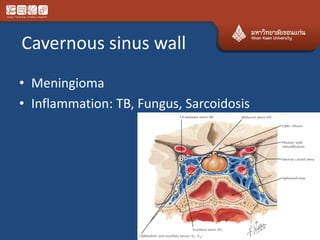Cavernous sinus wall
• Meningioma
• Inflammation: TB, Fungus, Sarcoidosis
 