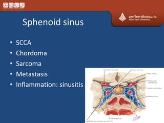 Sphenoid sinus
• SCCA
• Chordoma
• Sarcoma
• Metastasis
• Inflammation: sinusitis
 
