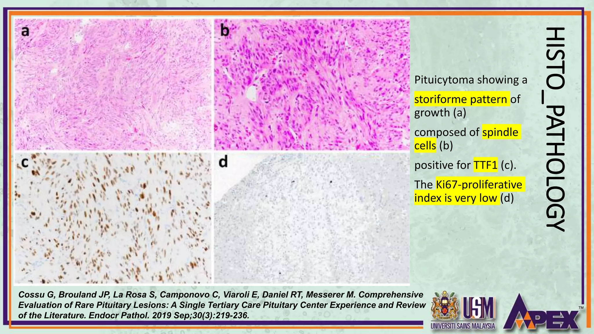 Spingle Pattern Pathology Sellar Region Tumors.pptx
