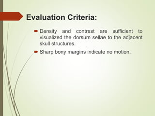 Evaluation Criteria:
 Density and contrast are sufficient to
visualized the dorsum sellae to the adjacent
skull structures.
 Sharp bony margins indicate no motion.
 