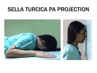 SELLA TURCICA PA PROJECTION
 