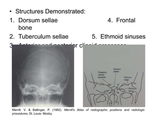 • Structures Demonstrated:
1. Dorsum sellae 4. Frontal
bone
2. Tuberculum sellae 5. Ethmoid sinuses
3. Anterior and posterior clinoid processes
Merrill, V. & Ballinger, P. (1982). Merrill's Atlas of radiographic positions and radiologic
procedures. St. Louis: Mosby.
 