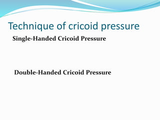 Technique of cricoid pressure
Single-Handed Cricoid Pressure
Double-Handed Cricoid Pressure
 