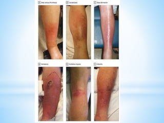 selulitis ppt | PPTX