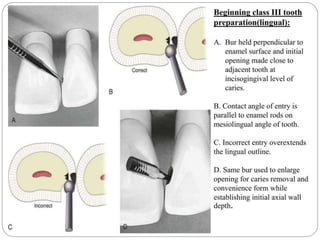 Class III, IV, V Cavity preparations for Composites- SELVI | PPTX