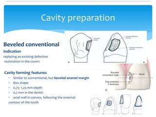 Class III, IV, V Cavity preparations for Composites- SELVI | PPTX