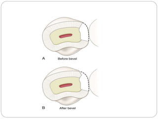 Class III, IV, V Cavity preparations for Composites- SELVI | PPTX