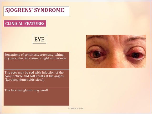 Inflammatory n infectious diseases of salivary gland- Dr 
