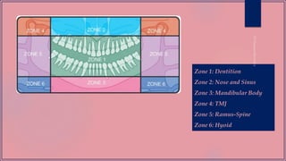 Zone 1: Dentition
Zone 2: Nose and Sinus
Zone 3: Mandibular Body
Zone 4: TMJ
Zone 5: Ramus-Spine
Zone 6: Hyoid
 