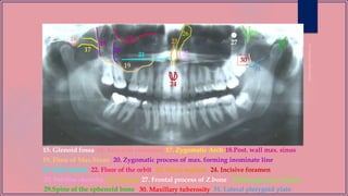 15
15. Glenoid fossa
19. Floor of Max.Sinus
17. Zygomatic Arch16. Articular eminence 18.Post. wall max. sinus
20. Zygomatic process of max. forming inominate line
21. Hard palate 22. Floor of the orbit 23. Nasal septum 24. Incisive foramen
25. Inferior choncha 26. Meatus 27. Frontal process of Z.bone
16
17
18
19
20
21
22
23
29
25
24
26
28.Pterygo max. fissure
30. Maxillary tuberosity29.Spine of the sphenoid bone 31. Lateral pterygoid plate
31
30
28
27
 