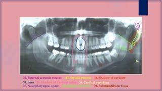 32
32. External acoustic meatus 34. Shadow of ear lobe33. Styloid process
35. nose 36. Shadow of Cervical spine
33
34
35
36 36
36. Cervical vertebrae
37
37. Nasopharyngeal space 38. Shadow of uvula
39
38
39. Submandibular fossa
 